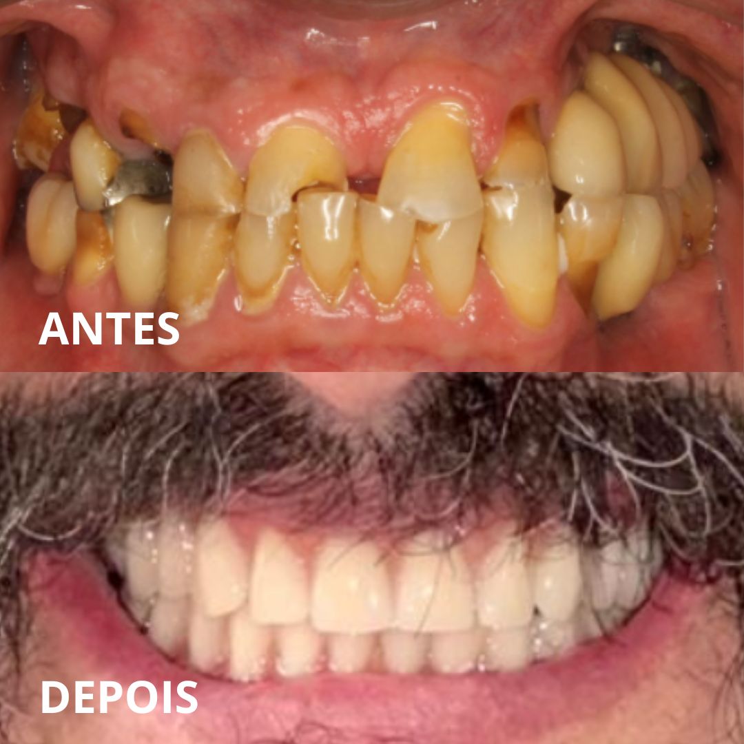 ANTES (1)